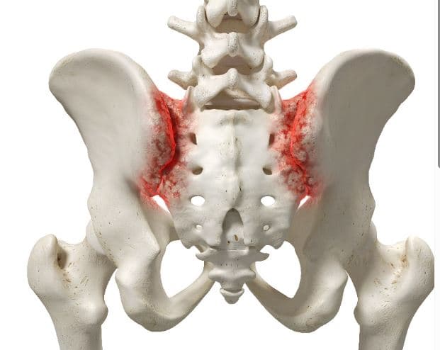 التهاب | خشونة المفصل العجزي الحرقفي