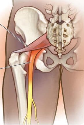 متلازمة العضلة الكمثرية | عرق النسأ الكاذب