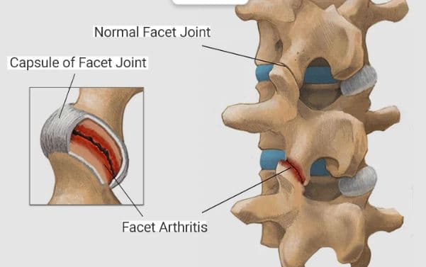 متلازمة المفصل الوجيهي |مفاصل الفقرات