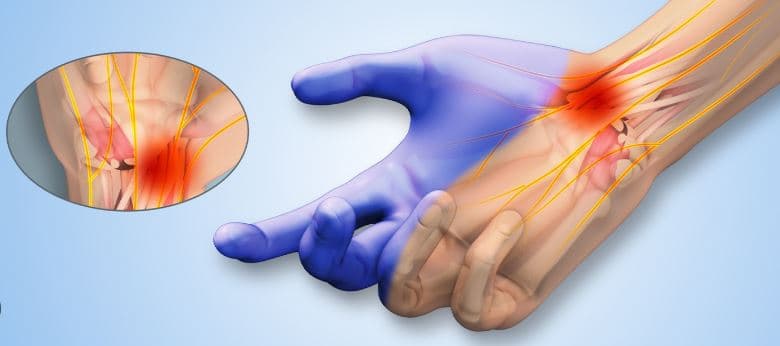 متلازمة النفق الرسغي