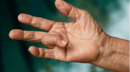 الإصبع الزنادي | التهاب غمد الوتر المتضيق